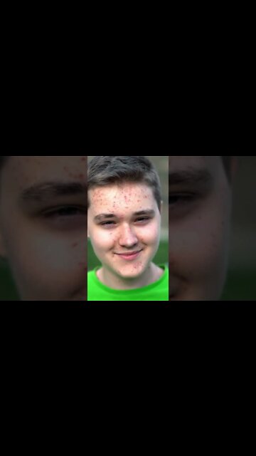 Get Rid of Blackheads Naturally #short