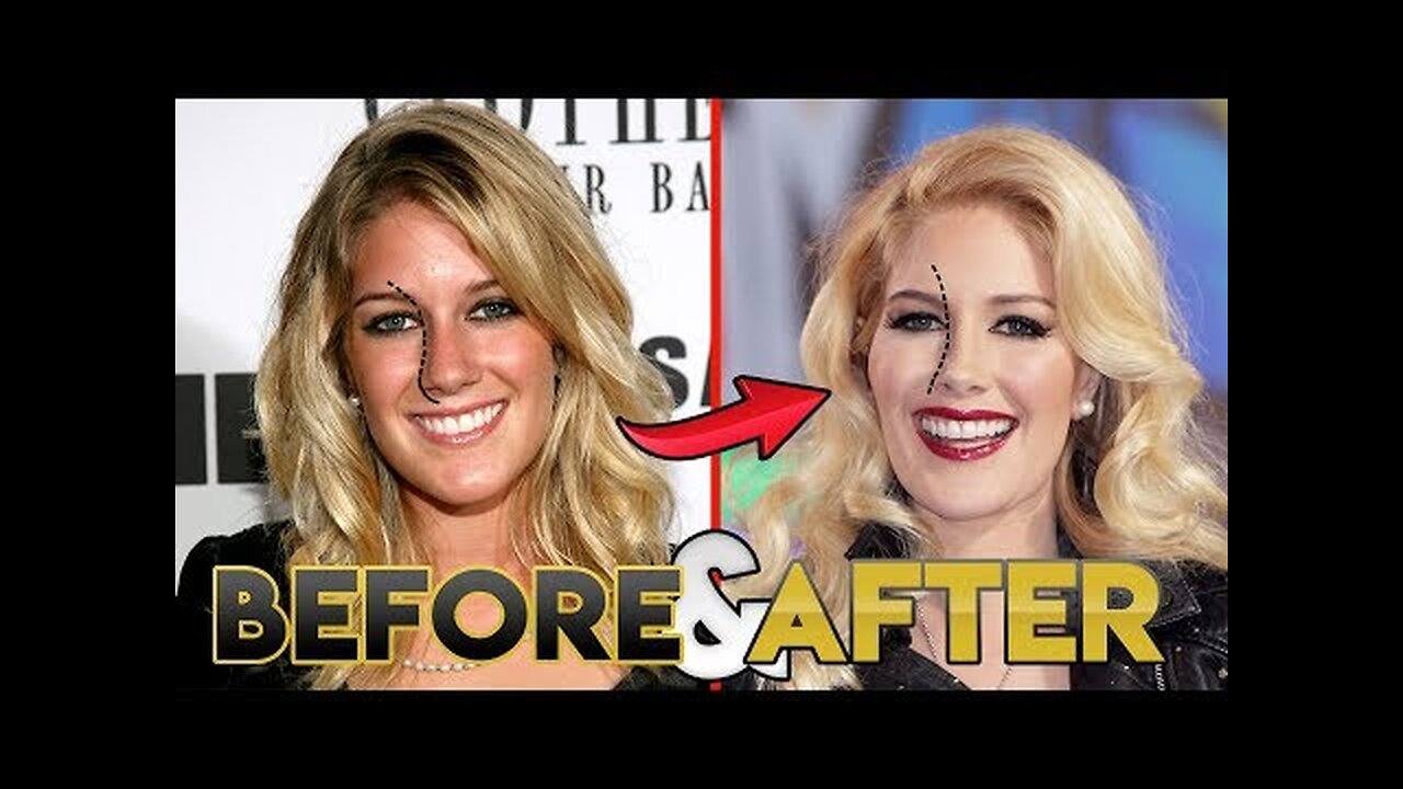 Heidi Pratt | Before and After Transformations | Heidi Montag from The Hills