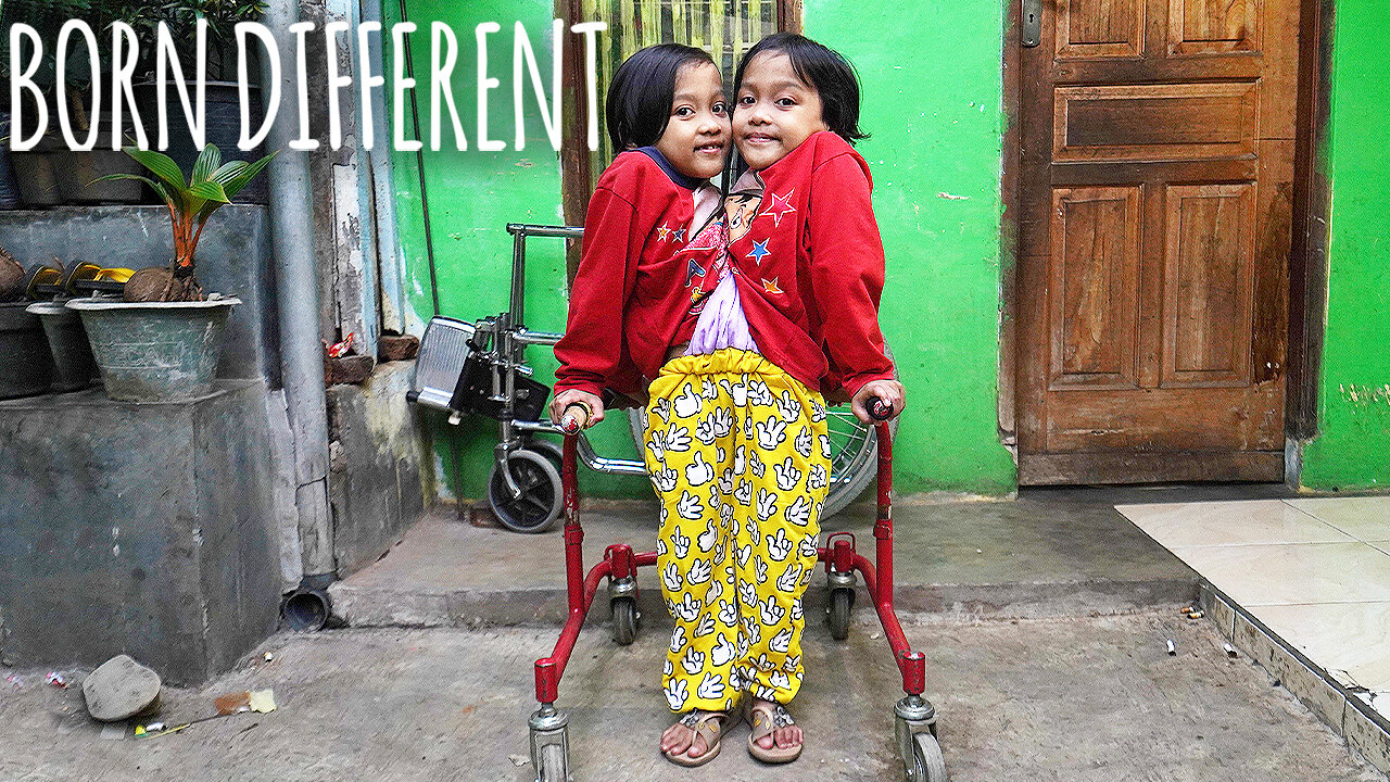 We're Conjoined Twins Who Share Legs | BORN DIFFERENT