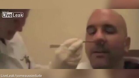 Graphic footage shows tapeworm extraction from man's NOSE