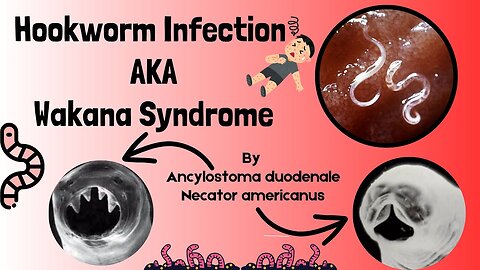 Hookworm, Causes, Signs and Symptoms, Diagnosis and Treatment | Intestinal Nematodes | Novice Medic