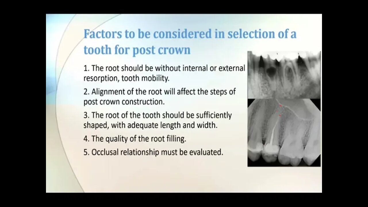 Operative L14 (Fixed Prosthodontics:Restoration Of Endodontically Treated Teeth "Post Crown")