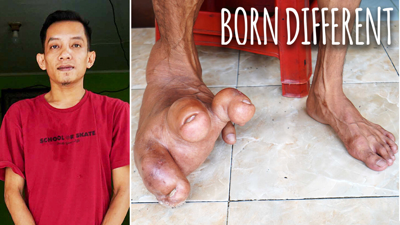 The Man With The Giant Foot | BORN DIFFERENT