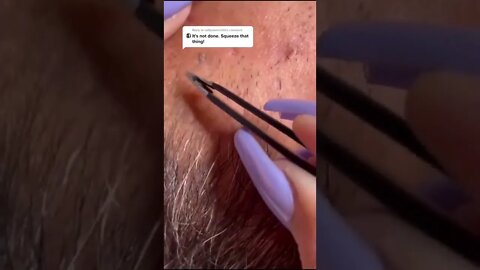 Satisfying Ingrown Hair Removal #shorts