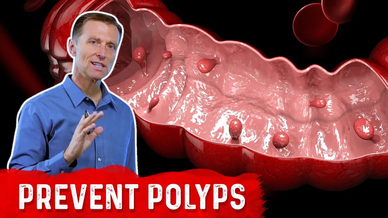 What is a Polyp? – The Best Food for Colon Polyp Prevention – Dr. Berg