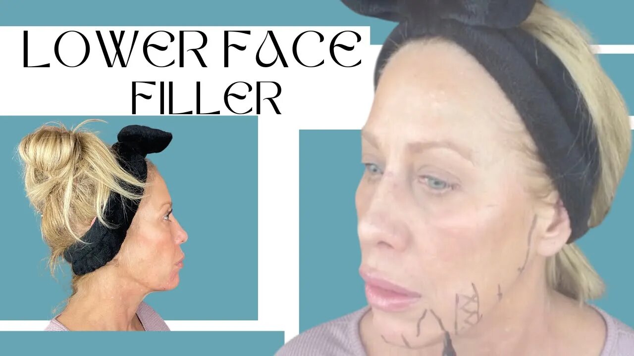 Jawline, Chin & Prejowl Sulcus Filler