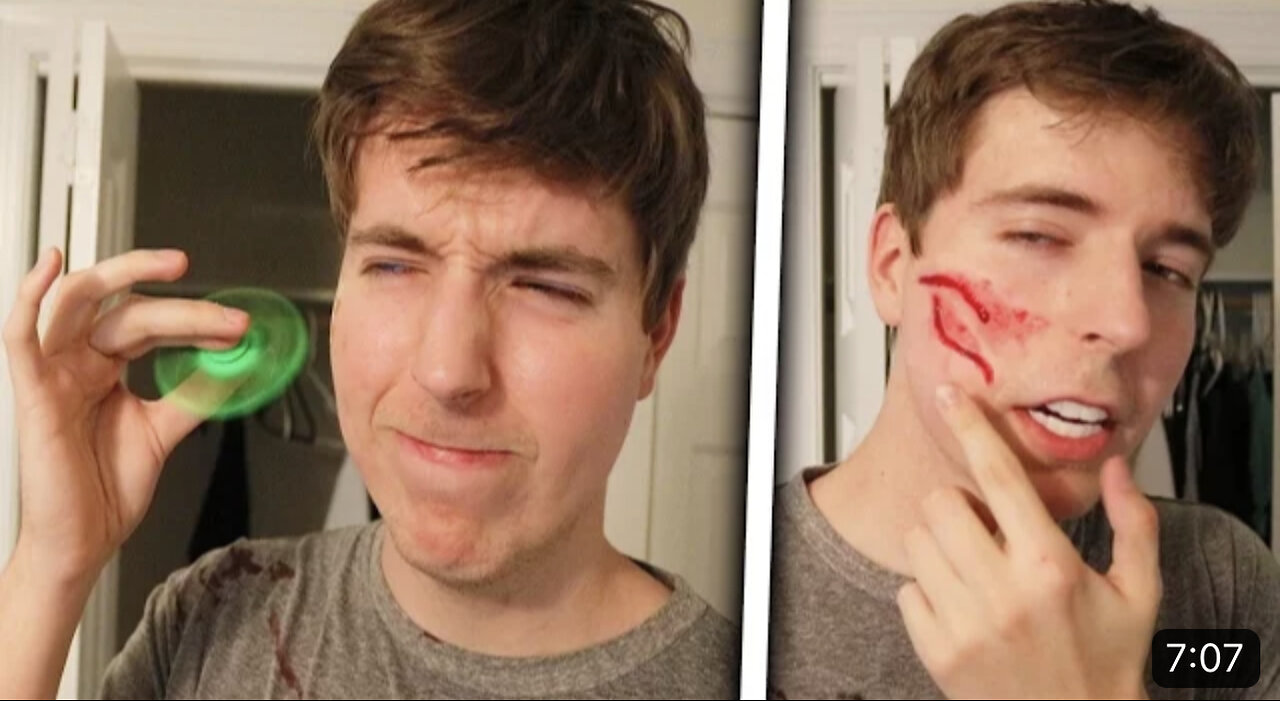 Fidget spinner VS Face (Legit had to get stitches)