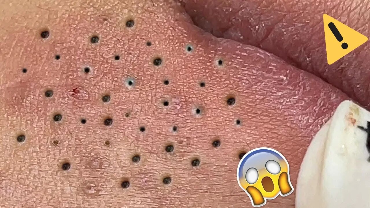 Espremendo cravos grandes e pretos Video satisfatorio Blackhead Extractions blackhead