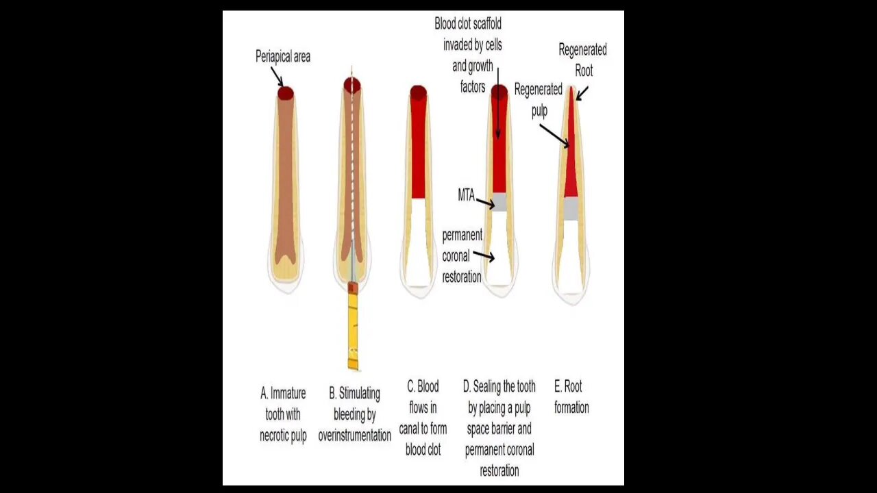 Pedodontics L6 (Part2) & L7 (Regenerative Endodontic & MTA)