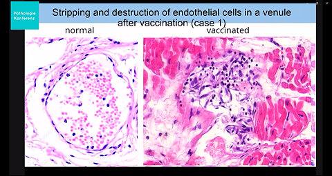 Finally: Indisputable evidence that the "vaccines" damage internal organs (blood vessels, brain)