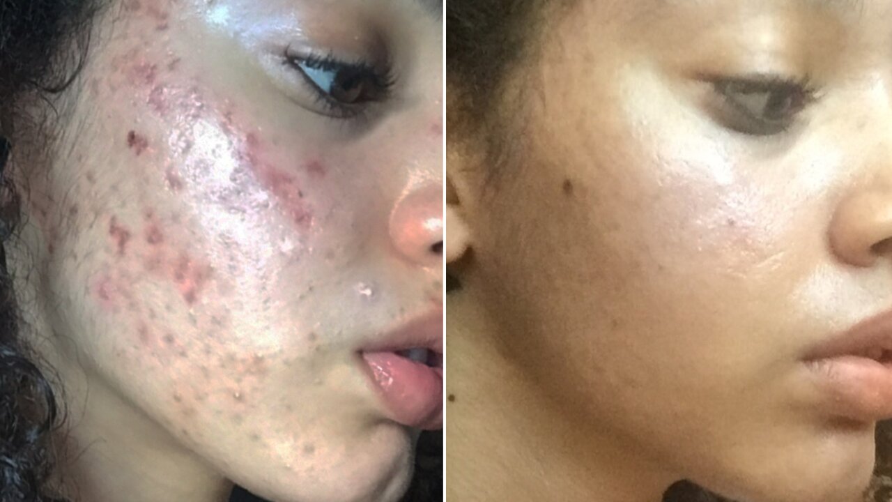 ACNE HEALING AND CONTROL PROTOCOLS Updated Apr 24th 2022