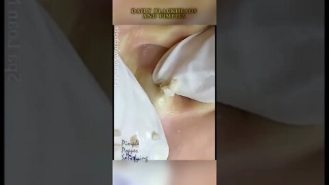 Hidden Acne Inside Ear - blackheads removal