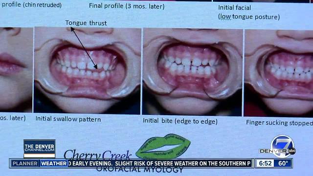Orofacial myology: Training face muscles for long term change