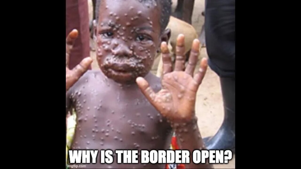 Monkeypox Is Here And The Government Wants To Scare You