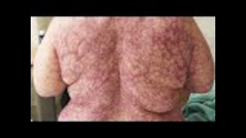 Woman breaks out in web like, purple rash after cold weather in New York