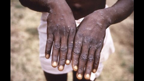 MONKEYPOX DISEASE ON IT'S WAY HERE!