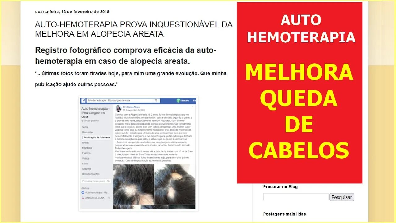 Auto-hemoterapia melhora alopecia (queda de cabelos)