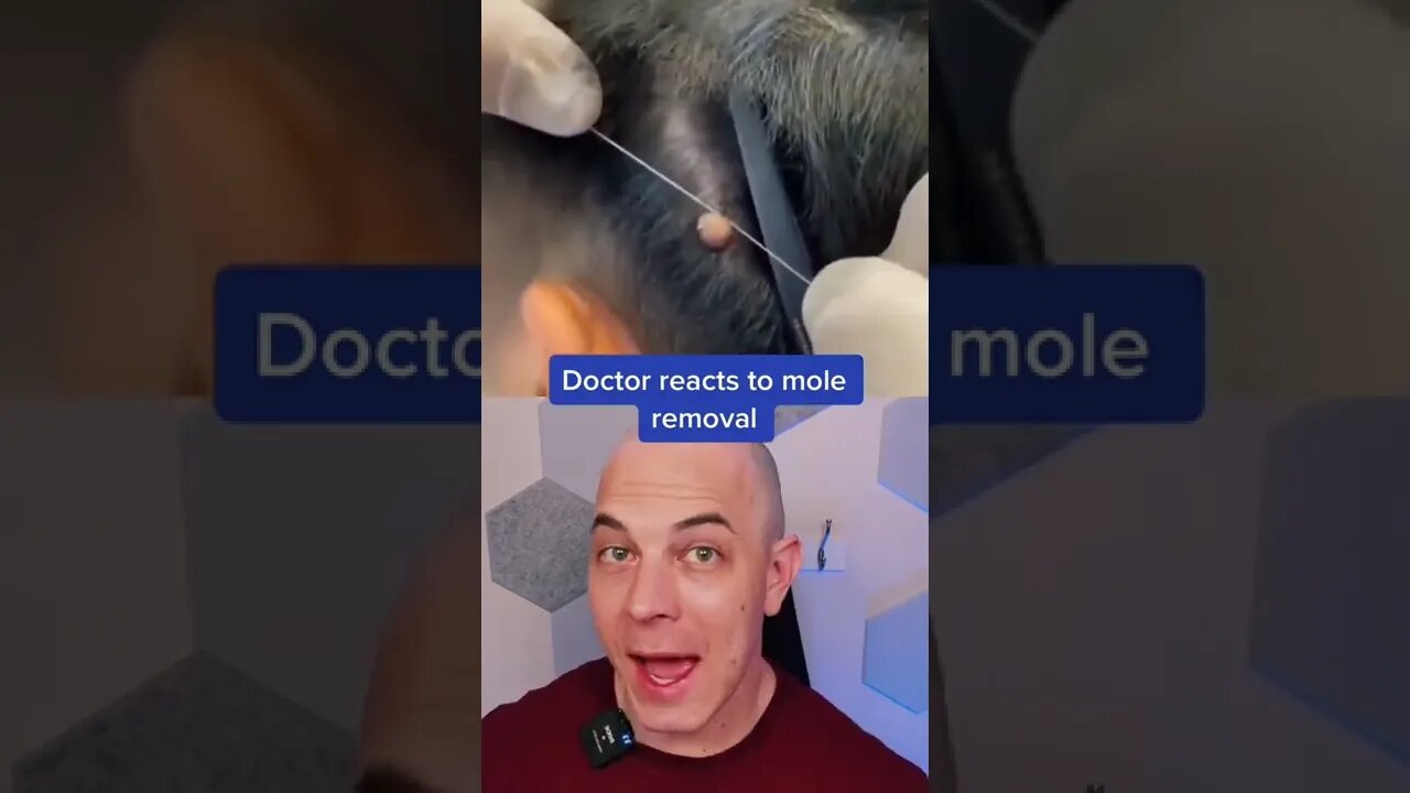 Do not do this! Mole removal