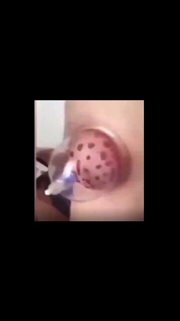 Covid Clot Clump Sucked Out and Shown