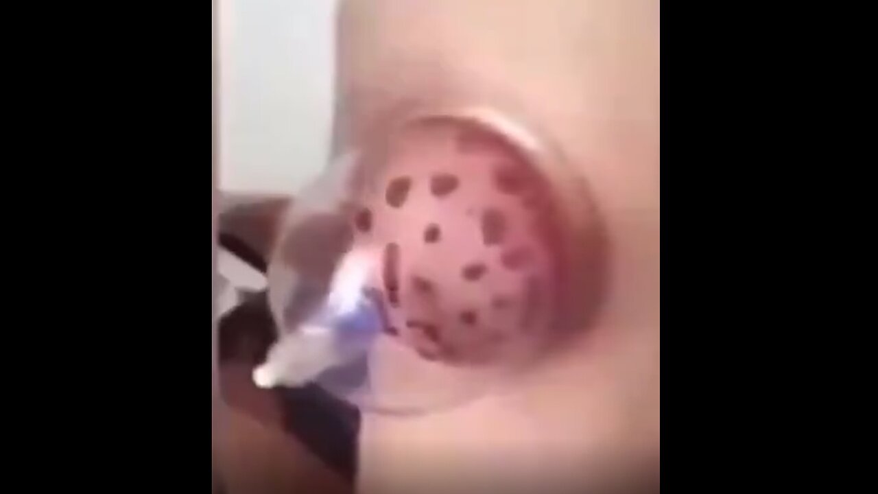 Covid Clot Clump Sucked Out and Shown