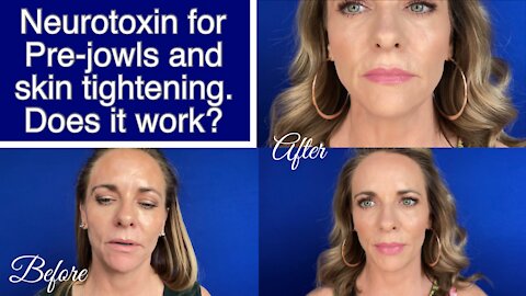 'Tox to Tighten Jowls & Skin