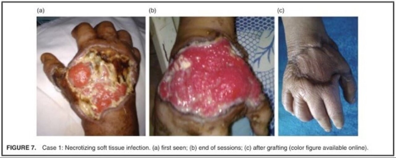 The Power of Ozone Therapy For Diabetic Non Healing Wounds