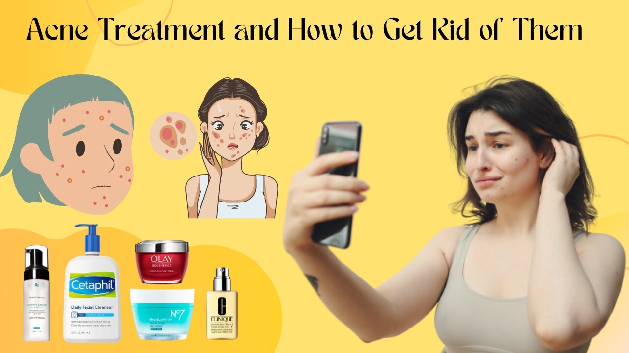 How to get rid of acne | How to remove acne from face | Acne treatment