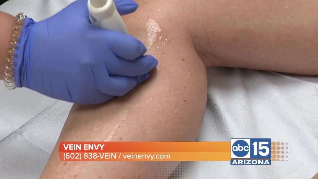 Vein Envy helps patients with their vein health