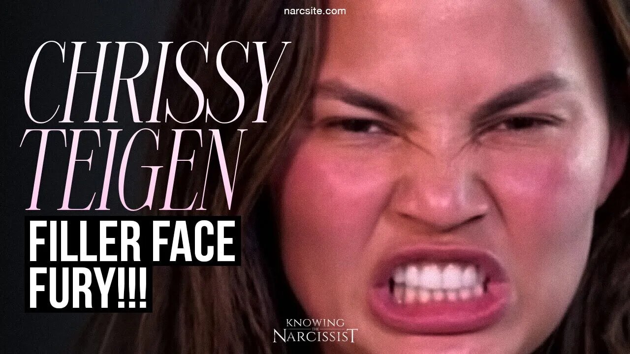 Chrissy Teigen : Face Filler Fury