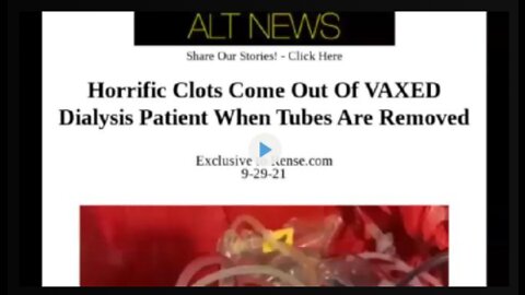 Horrific Blood Clots Come Out of VAXXED Dialysis Patient When Tubes Are Removed!!!