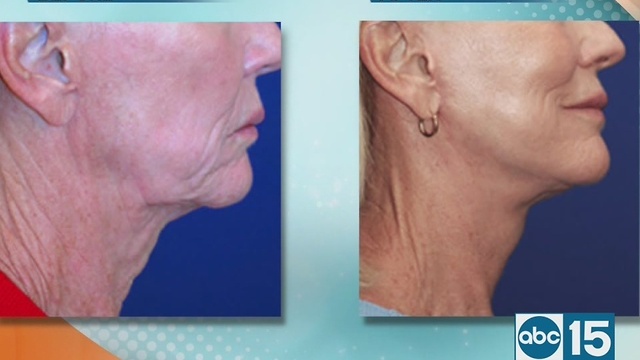 Dermacare Cosmetic Surgery offers lasting beauty with Lasting Facelift