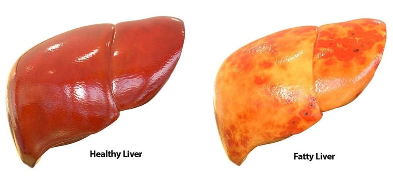 1 Teaspoon Cleans Out Fat in Your Liver