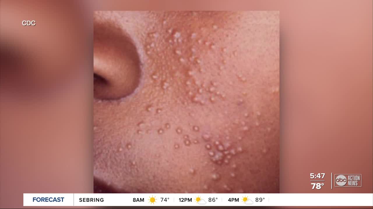 Local pediatrician advises parents on treating molluscum, viral skin infection common with kids