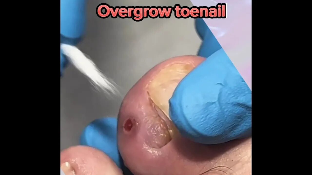 Overgrow toenail 😱 Removing #toenails