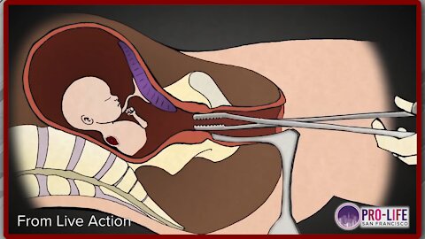 Disturbing: Tax-Funded Abortion Harvesting Operation Exposed - 2330