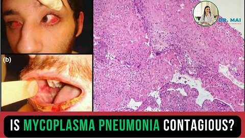 Is mycoplasma pneumonia contagious? | DR. MAI