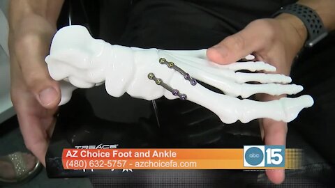 Bunions are a 3D problem- Here's a 3D solution