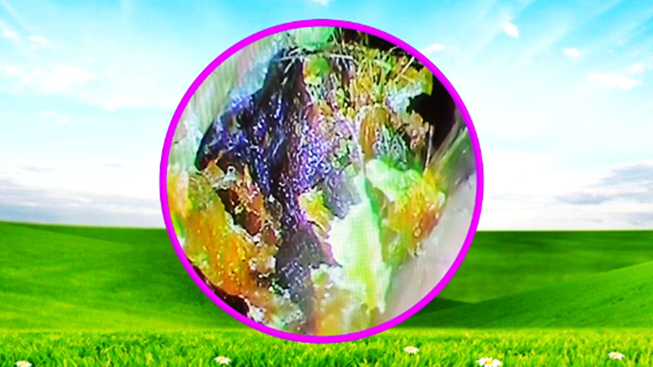 Earwax Extraction Relaxing with Flute Music #04