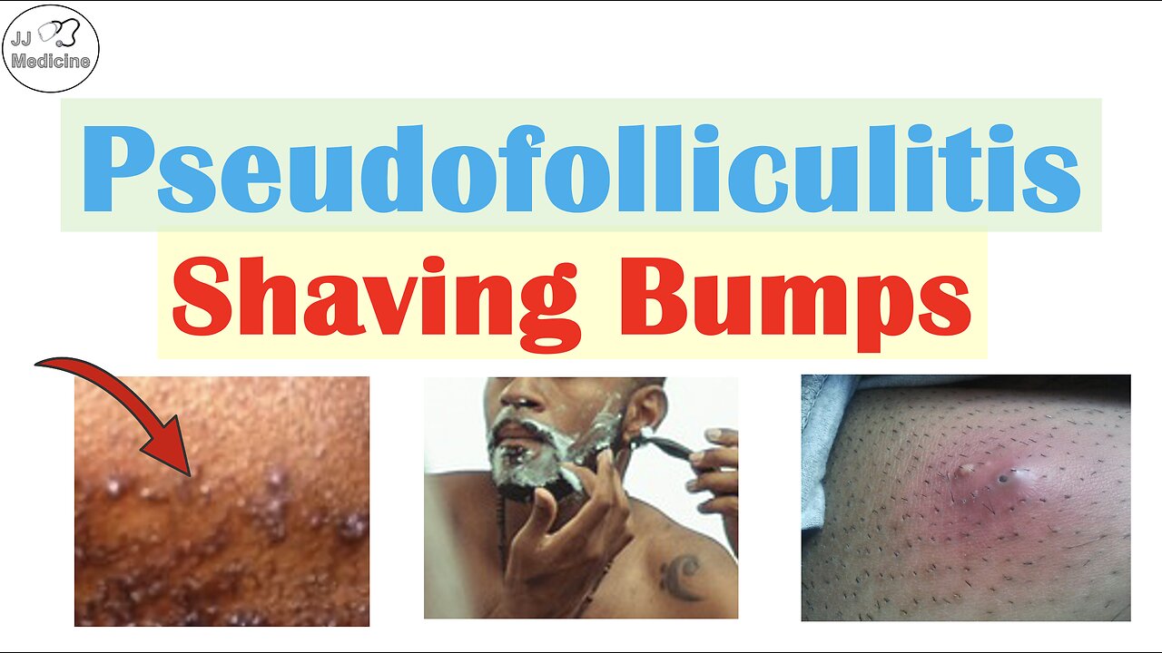 Pseudofolliculitis Barbae & Pubis (Shaving Bumps): Causes, Pathophysiology, Complications, Treatment