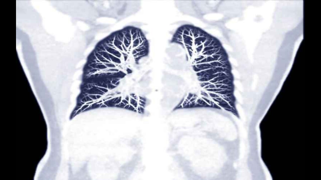 Study: COVID Survivors Double Their Risk for Lung Blood Clots