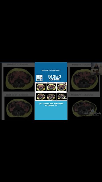 Deadly visceral fat. It’s the pink stuff in video. How do you lose it? Remove processed carbs.