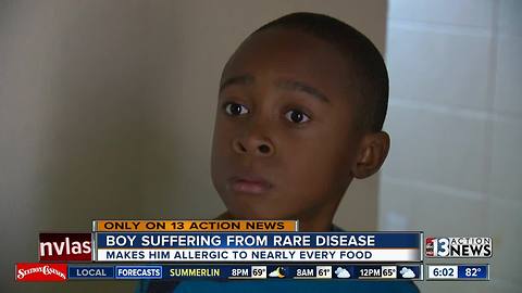 10-year-old Las Vegas boy allergic to nearly all foods