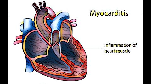 Post Jab Myocarditis In Young Athlete