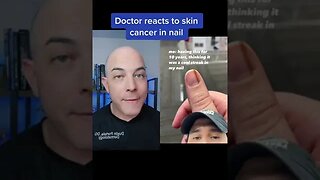 Derm reacts to skin cancer in a fingernail! #fingernail #skincancer #dermreacts