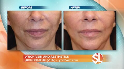 Lynch Vein and Aesthetics introduces us to the latest technology to help with acne scars, stretch marks and more!