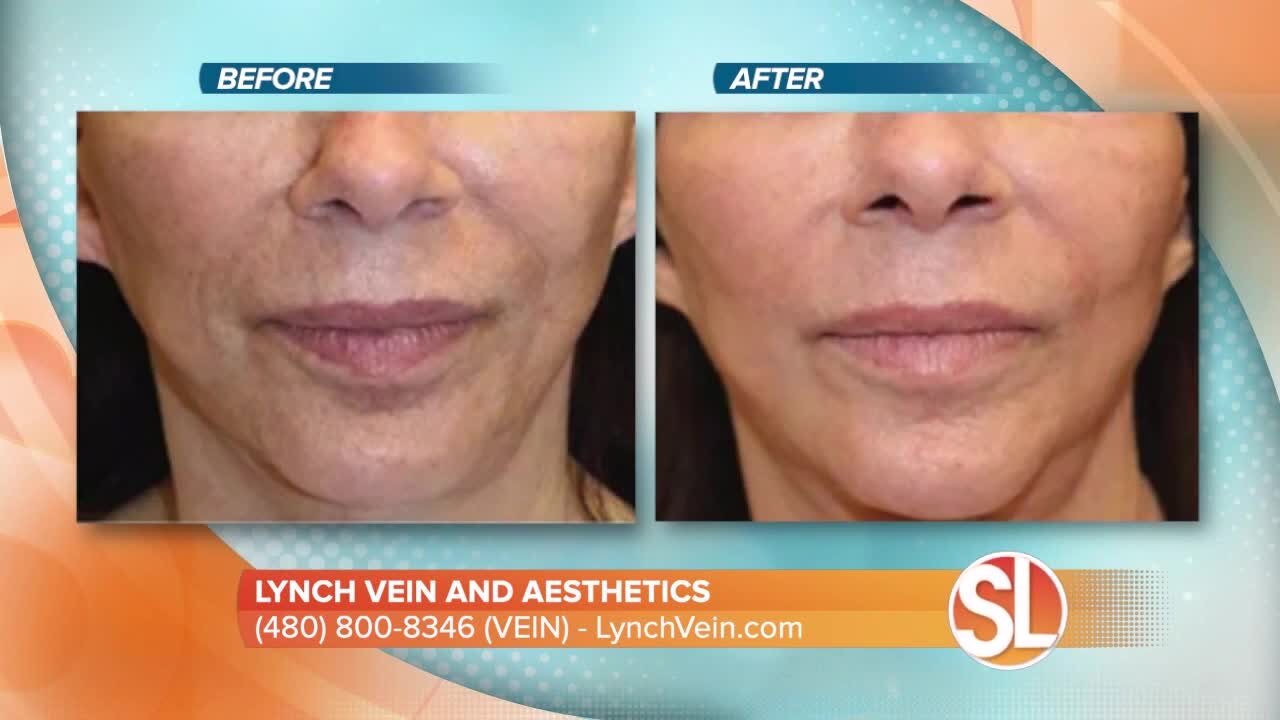 Lynch Vein and Aesthetics introduces us to the latest technology to help with acne scars, stretch marks and more!