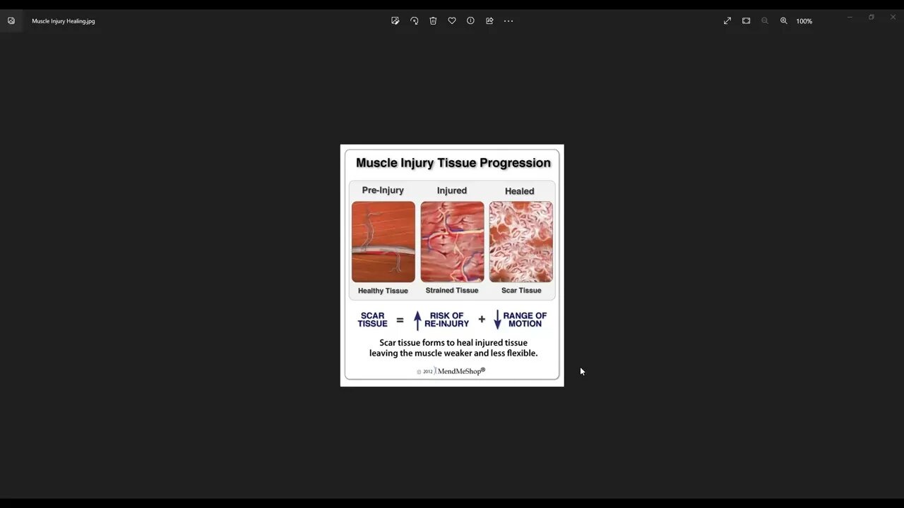 Personal Injury Muscle Scar Tissue