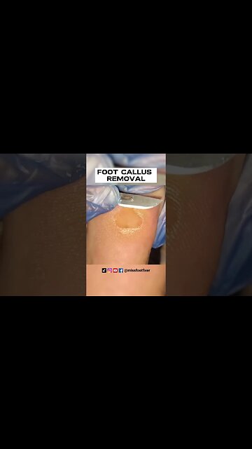 FOOT CALLUS REMOVAL 2022 (PAINLESS PROCEDURE) | SATISFYING CALLOUS TREATMENT BY MISS FOOT FIXER
