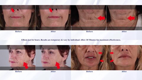 Look Young And Radiant With Plexaderm