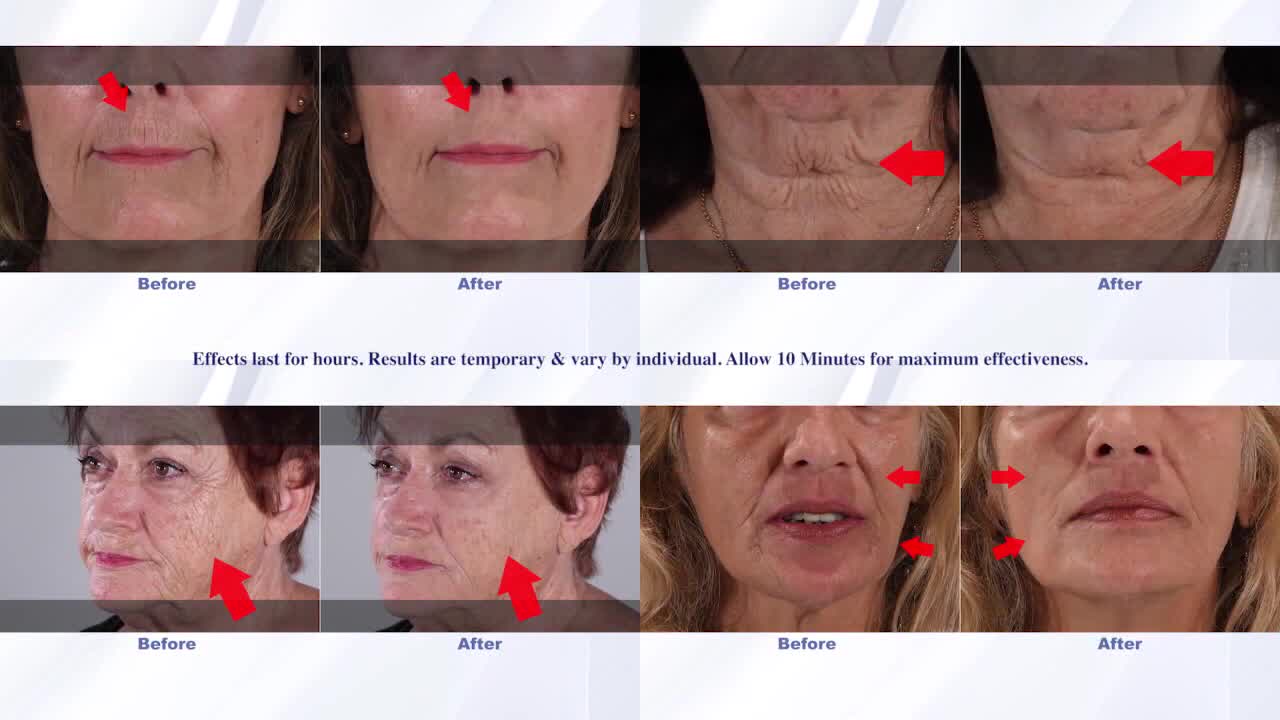 Look Young And Radiant With Plexaderm